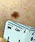 Skin Cancer, Cyst & Mole Removal, Removing Skin Cancer, Growth, Cyst and Mole without stitching.